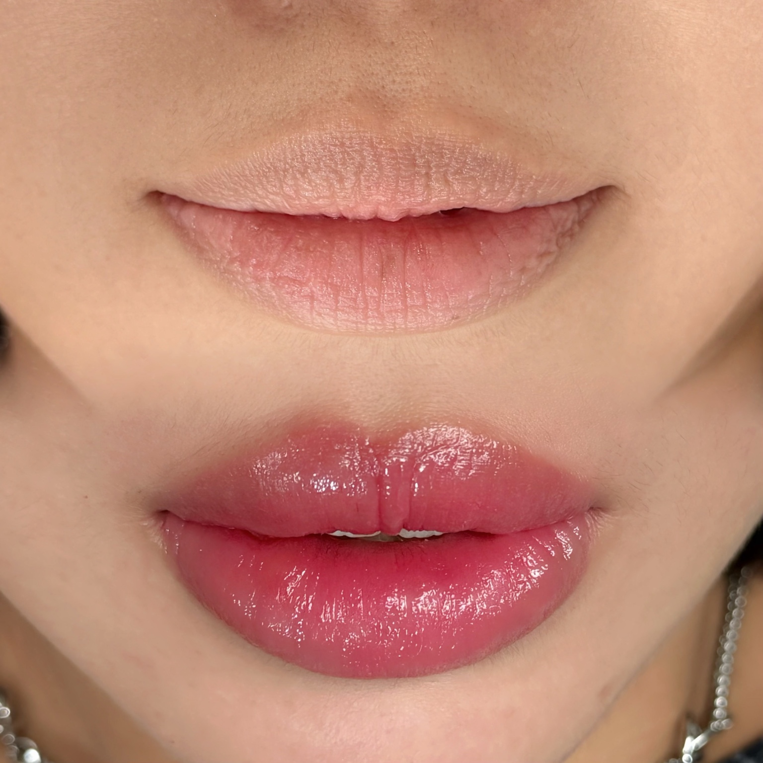 DIF.ME Dark Lip Correction before and after treatment photo 7