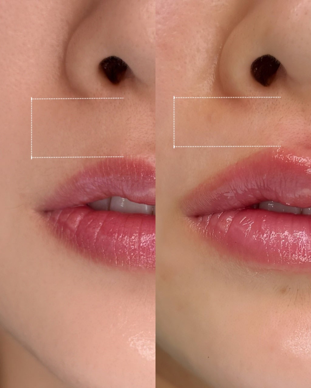 DIF.ME Lip Line treatment photo 3
