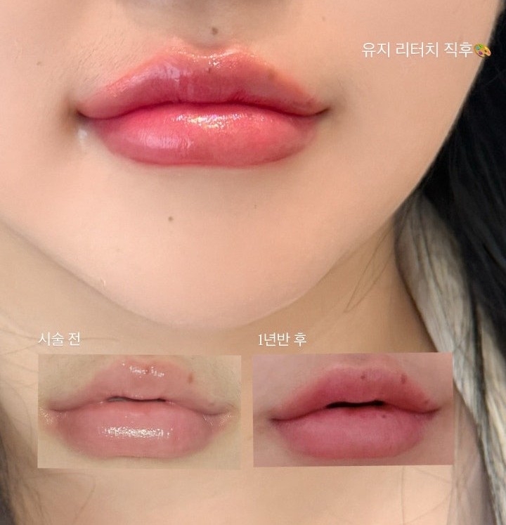 DIF.ME Over Lip treatment photo 2