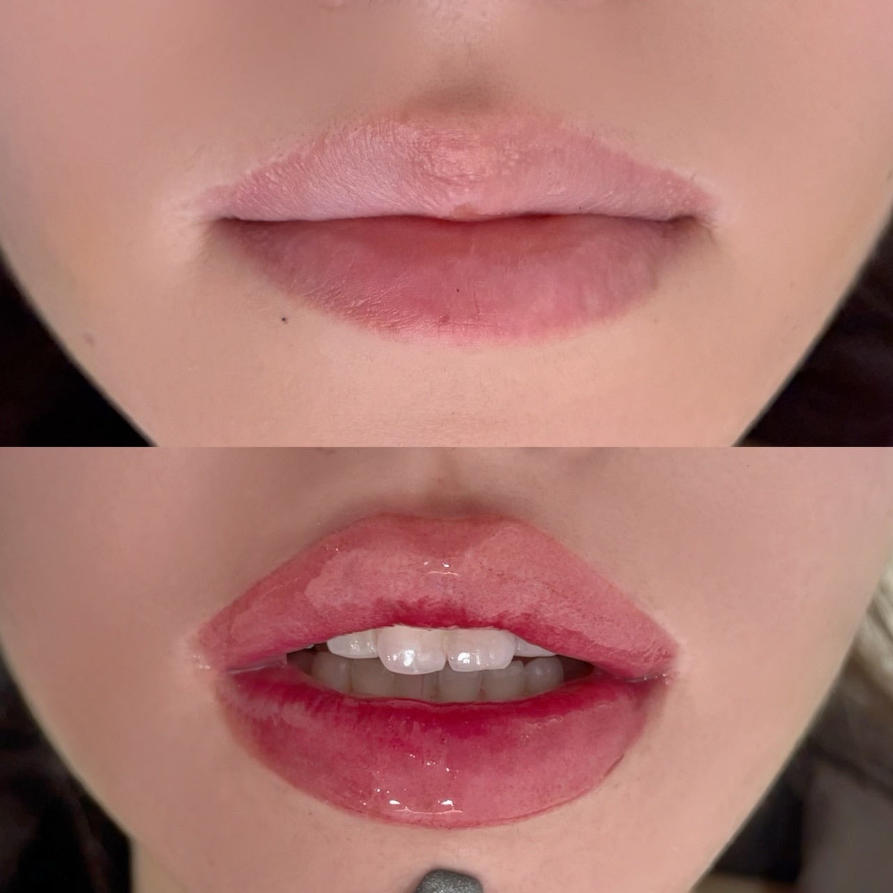 DIF.ME Over Lip treatment photo 3