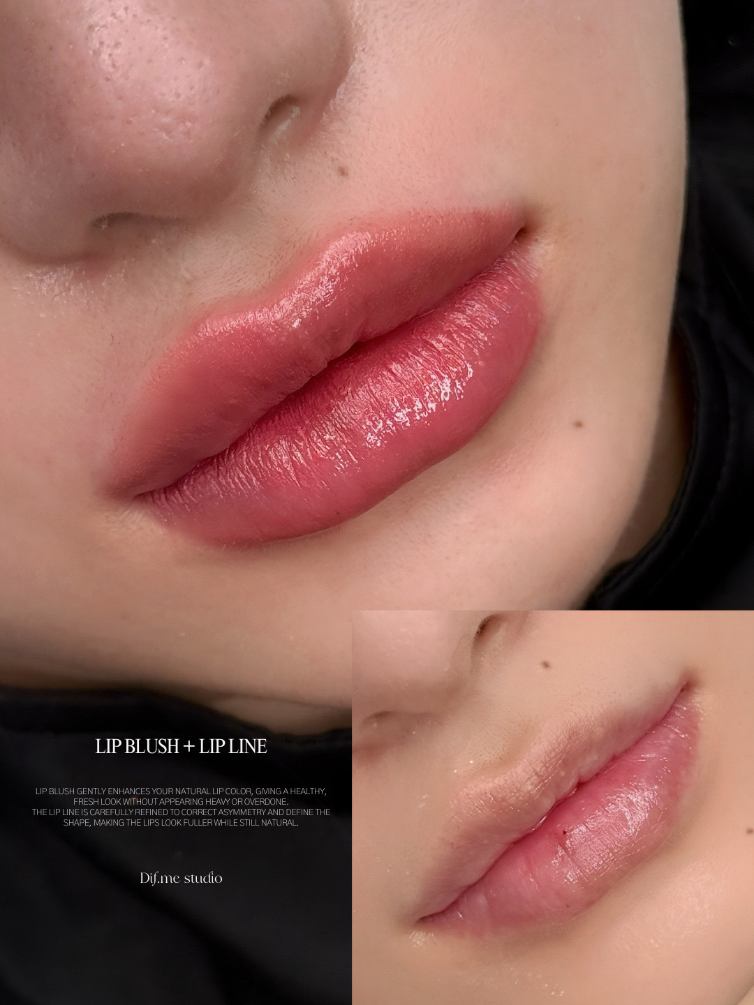 DIF.ME Over Lip treatment photo 4
