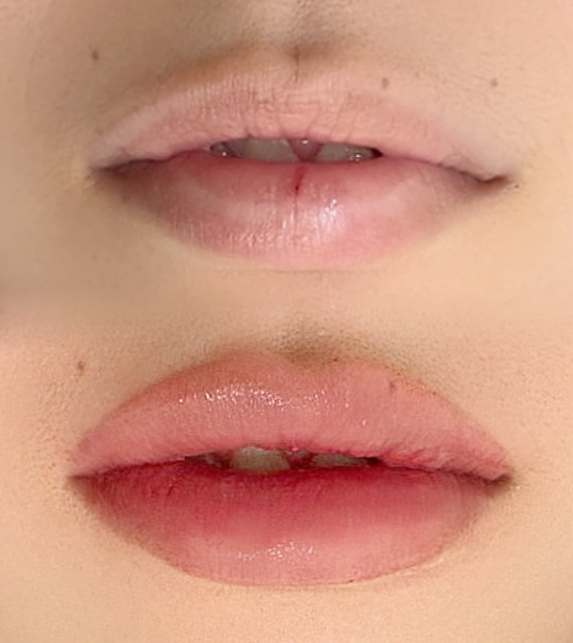 DIF.ME Over Lip treatment photo 6